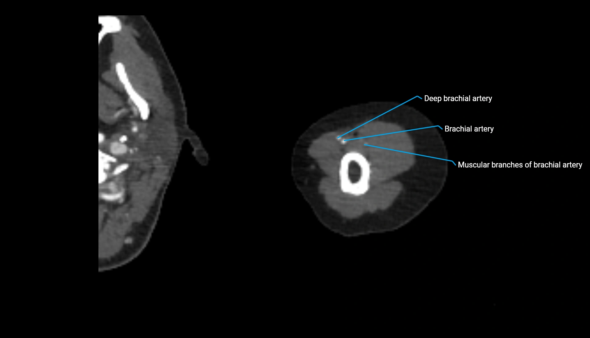 CTA upper limb axial cross sectional anatomy labelled image 276 (1).webp